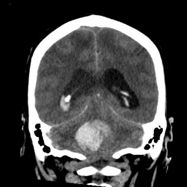 File:Cerebellar hemorrhage causing obstructive hydrocephalus (Radiopaedia 33989-35207 Coronal non-contrast 37).jpg