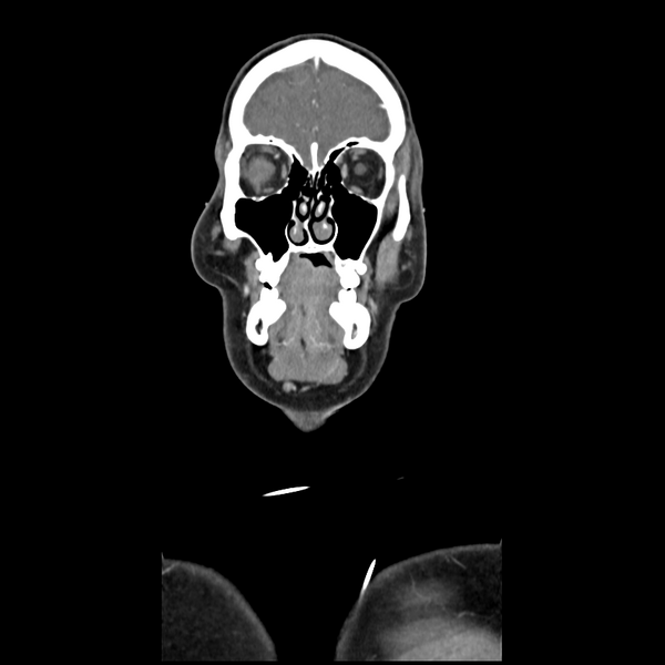 File:Cerebellar infarct due to vertebral artery dissection with posterior fossa decompression (Radiopaedia 82779-97029 D 12).png