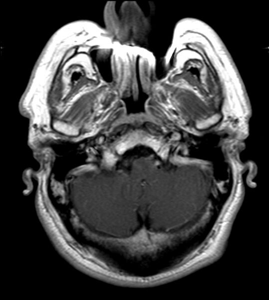 File:Cerebellopontine angle meningioma (Radiopaedia 24459-24764 Axial T1 C+ 4).jpg