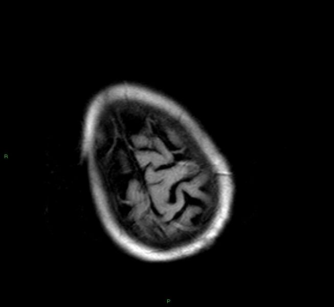 File:Cerebral amyloid angiopathy-associated lobar intracerebral hemorrhage (Radiopaedia 58377-65515 Axial FLAIR 4).jpg