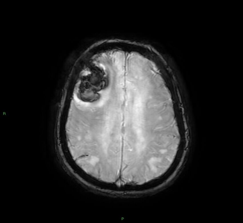 Cerebral amyloid angiopathy-associated lobar intracerebral hemorrhage (Radiopaedia 58378-65517 Axial SWI 52).jpg