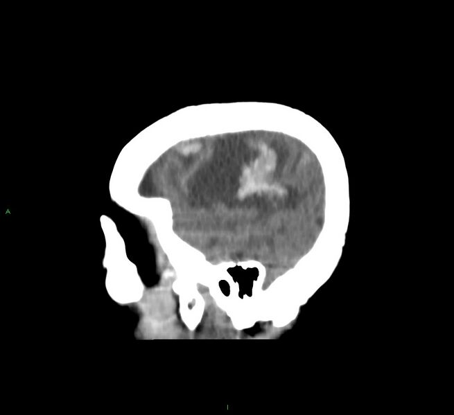 File:Cerebral amyloid angiopathy-associated lobar intracerebral hemorrhage (Radiopaedia 58751-65972 C 11).jpg