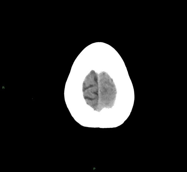 File:Cerebral amyloid angiopathy-associated lobar intracerebral hemorrhage (Radiopaedia 58754-65975 Axial non-contrast 13).jpg