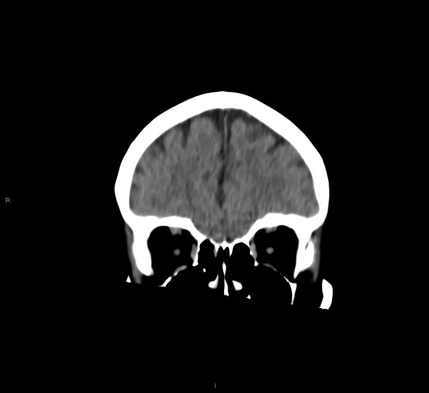 Cerebral amyloid angiopathy-associated lobar intracerebral hemorrhage (Radiopaedia 58757-65978 Coronal non-contrast 53).jpg