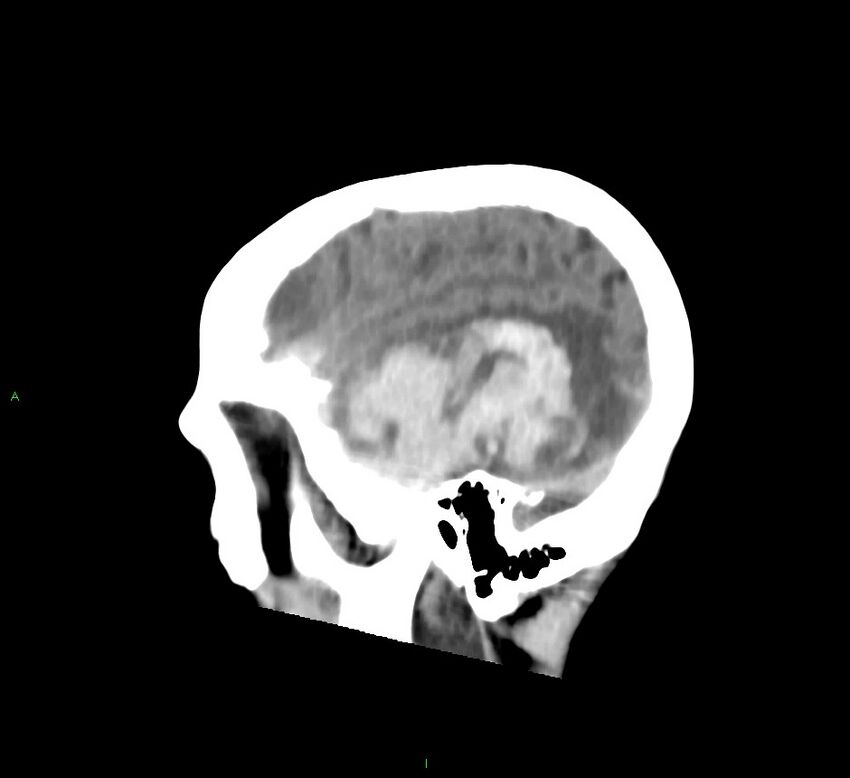 Cerebral amyloid angiopathy-associated lobar intracerebral hemorrhage (Radiopaedia 58758-65980 C 11).jpg