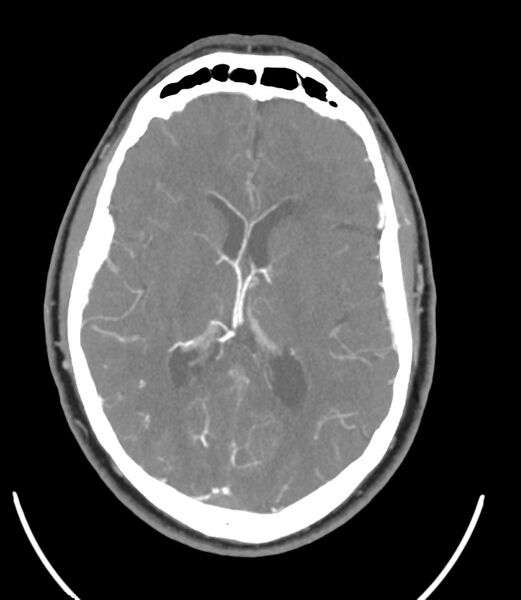 File:Cerebral dural venous sinus thrombosis (Radiopaedia 86514-102576 A 59).jpg