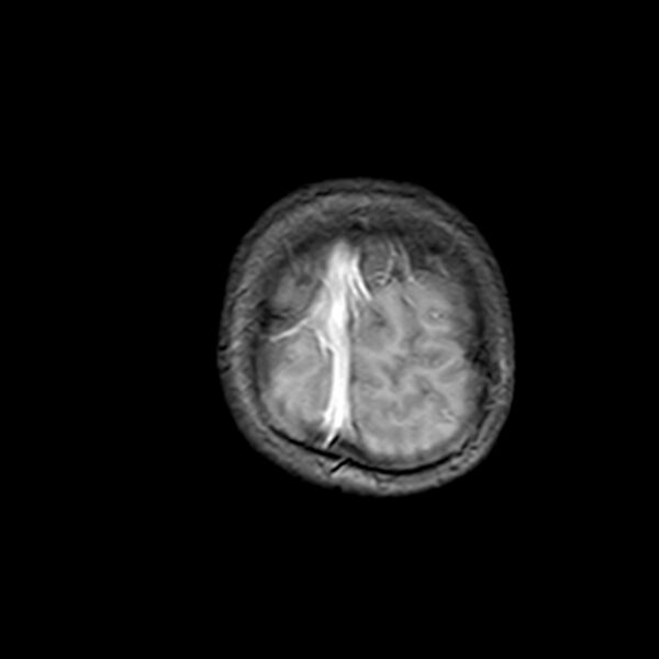 File:Cerebral tuberculoma (Radiopaedia 41152-43932 Coronal T1 C+ 22).jpg