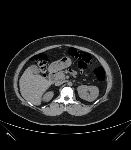 File:Cervical aortic arch with coarctation and aneurysms (Radiopaedia 44035-47552 Axial non-contrast 52).jpg