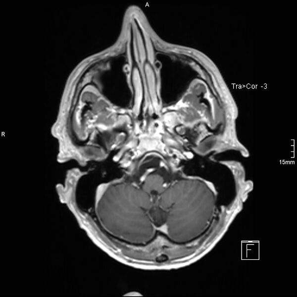 File:Cervical dural CSF leak on MRI and CT treated by blood patch (Radiopaedia 49748-54995 Axial T1 C+ 22).jpg