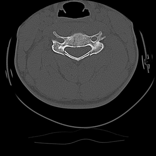 File:Cervical flexion teardrop fracture with cord hemorrhage (Radiopaedia 32497-33454 Axial bone window 42).jpg