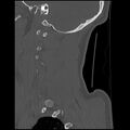 Cervical flexion teardrop fracture with cord hemorrhage (Radiopaedia 32497-33454 Sagittal bone window 7).jpg
