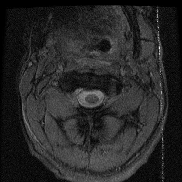 File:Cervical flexion teardrop fracture with cord hemorrhage (Radiopaedia 32497-33455 Axial Gradient Echo 3).jpg