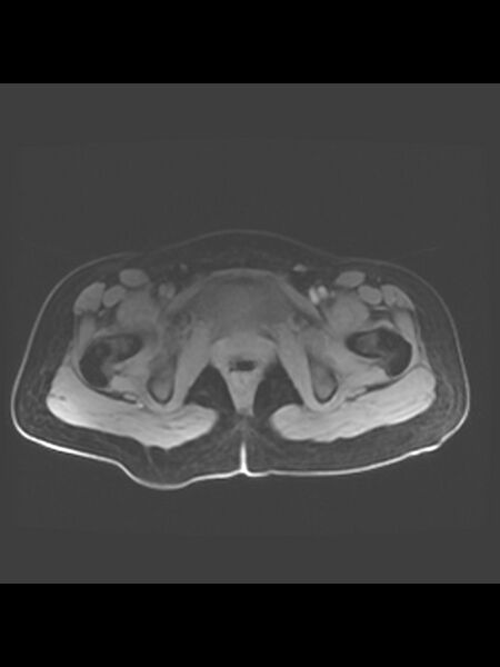 File:Cesarean section scar endometrioma (Radiopaedia 56569-63297 Axial T1 C+ fat sat 2).jpg