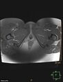 Cesarian scar endometriosis (Radiopaedia 68495-78066 Axial T1 C+ fat sat 28).jpg