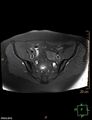 Cesarian scar endometriosis (Radiopaedia 68495-78066 Axial T1 fat sat 7).jpg