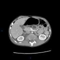 Chance fracture with duodenal and pancreatic lacerations (Radiopaedia 43477-46864 A 11).jpg