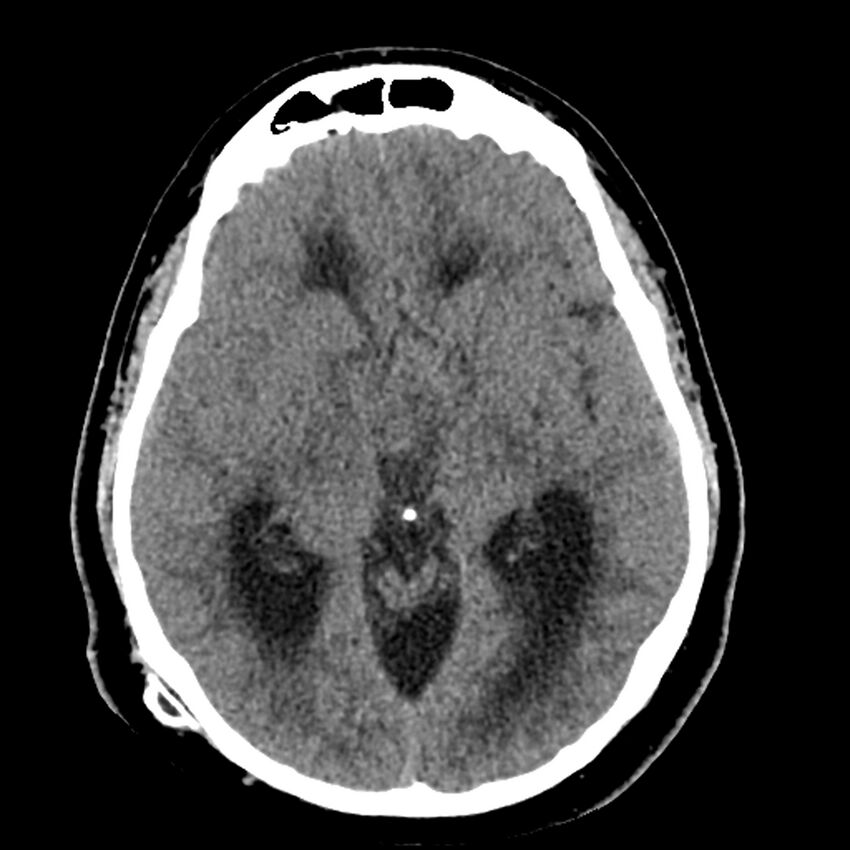 Chiasmatic-hypothalamic juvenile pilocytic astrocytoma (Radiopaedia 78533-91237 Axial non-contrast 27).jpg