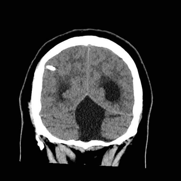 File:Chiasmatic-hypothalamic juvenile pilocytic astrocytoma (Radiopaedia 78533-91237 Coronal non-contrast 56).jpg