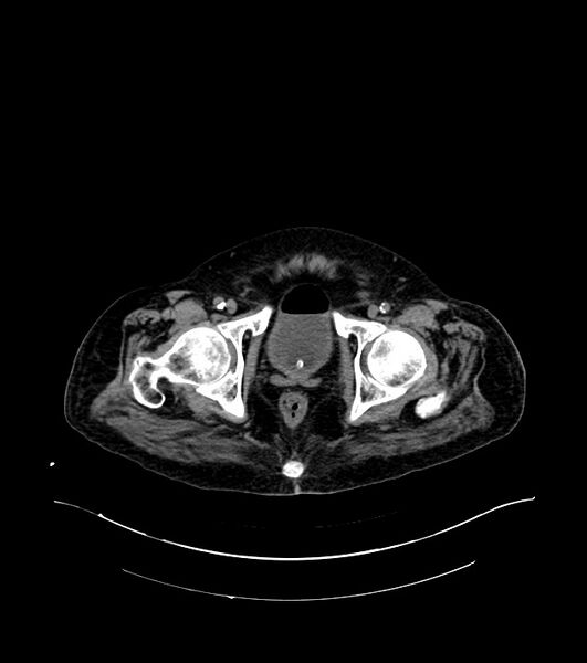 File:Cholangiocarcinoma with cerebral metastases (Radiopaedia 83519-98629 Axial non-contrast 121).jpg