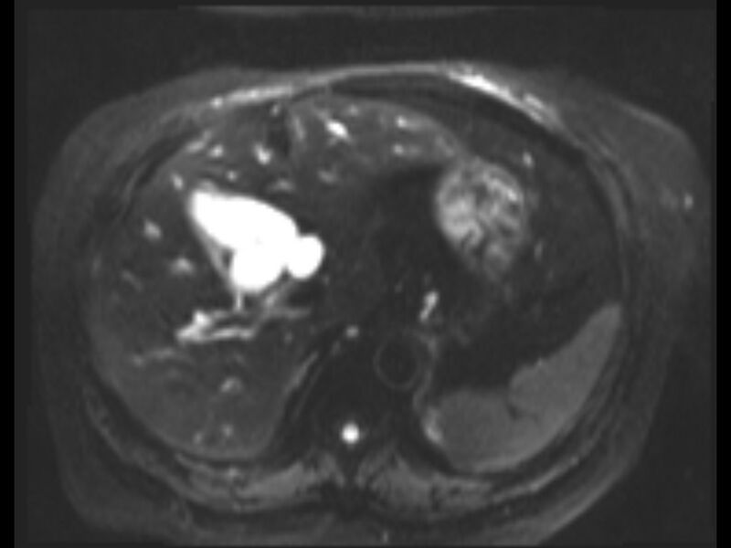 File:Choledocholithiasis causing intrahepatic biliary duct dilation (Radiopaedia 39908-42369 Axial T2 SPAIR 21).jpg