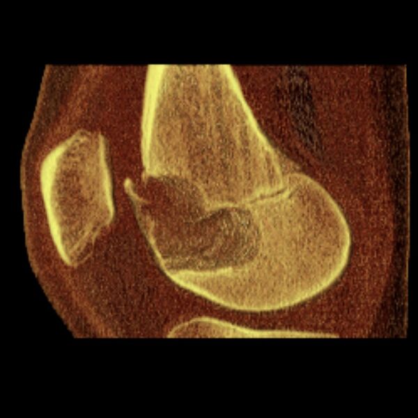 File:Chondroblastoma - distal femur (Radiopaedia 8112-8950 D 1).jpg