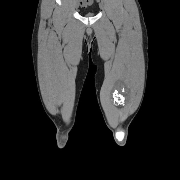 File:Chondrosarcoma arising from exostosis (Radiopaedia 59996-67507 Coronal soft tissue 5).jpg