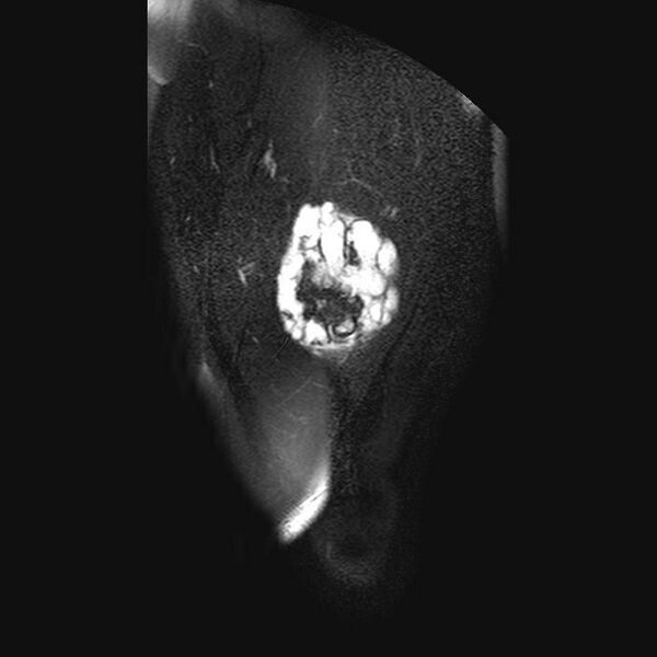 File:Chondrosarcoma arising from exostosis (Radiopaedia 59996-67686 C 3).jpg