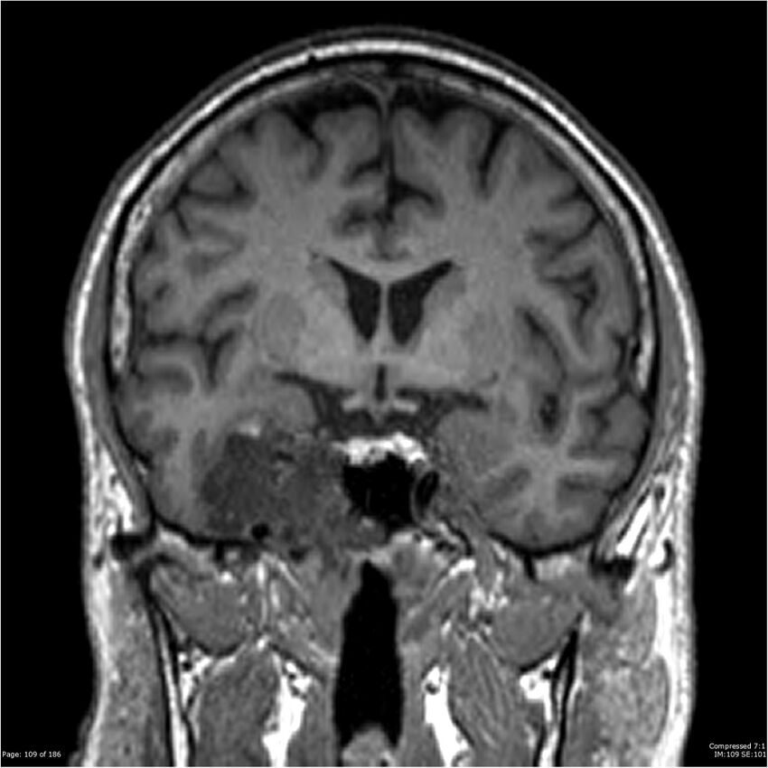 Chondrosarcoma of skull base- grade II (Radiopaedia 40948-43654 Coronal T1 30).jpg