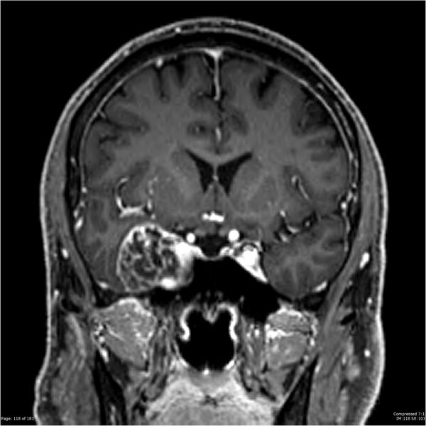 File:Chondrosarcoma of skull base- grade II (Radiopaedia 40948-43654 Coronal T1 C+ 29).jpg
