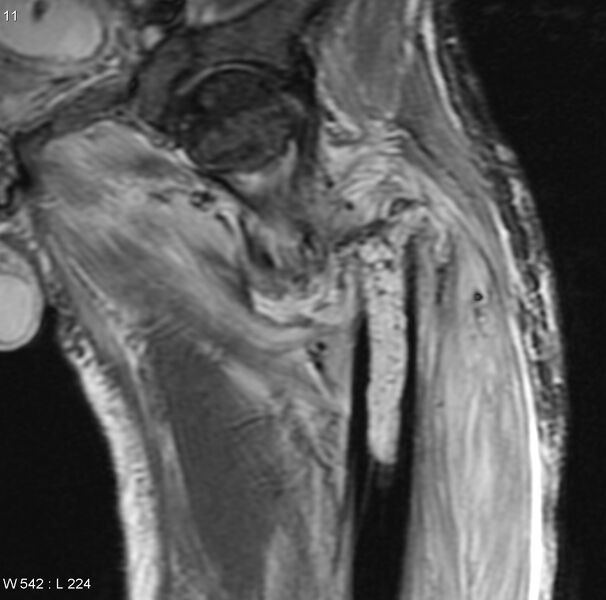 File:Chondrosarcoma with pathological fracture - femur (Radiopaedia 6174-7629 Coronal STIR 2).jpg