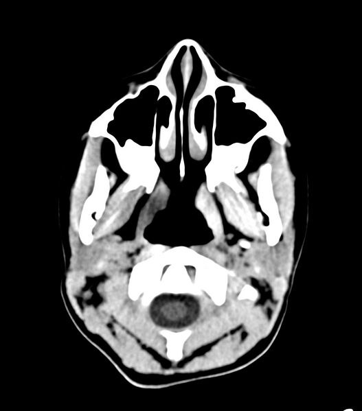 File:Choroid plexus carcinoma (Radiopaedia 91013-108552 Axial non-contrast 1).jpg