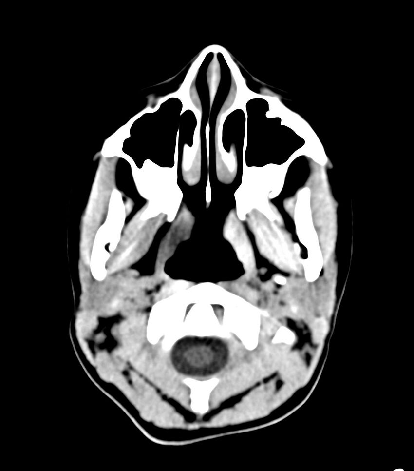 Choroid plexus carcinoma (Radiopaedia 91013-108552 Axial non-contrast 1).jpg