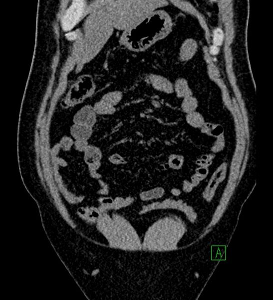 File:Chromophobe renal cell carcinoma (Radiopaedia 84286-99573 Coronal non-contrast 38).jpg