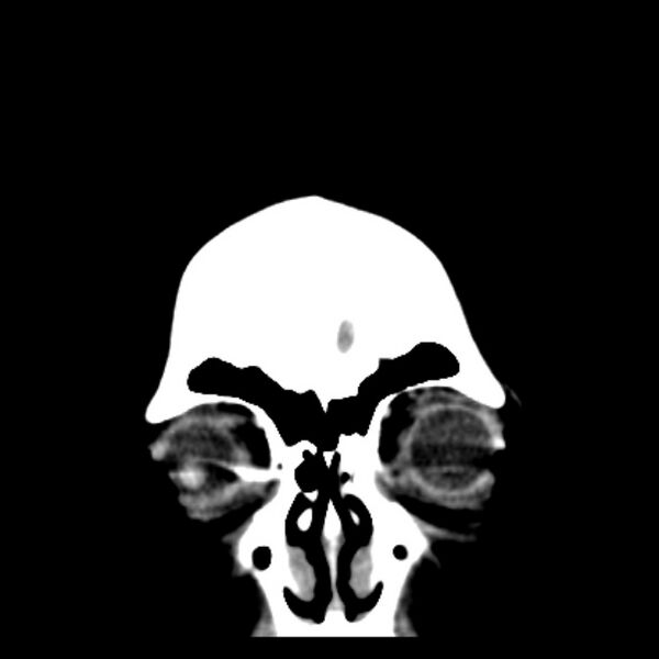 File:Chronic bilateral occipital lobe infarcts (Radiopaedia 31276-31996 Coronal non-contrast 6).jpg