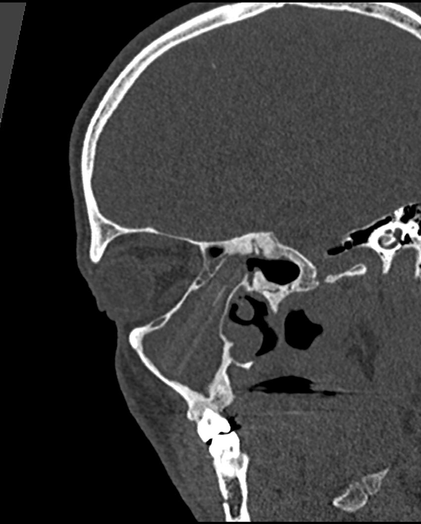 Chronic maxillary sinusitis caused by a foreign body (Radiopaedia 58521-65676 Sagittal bone window 31).jpg