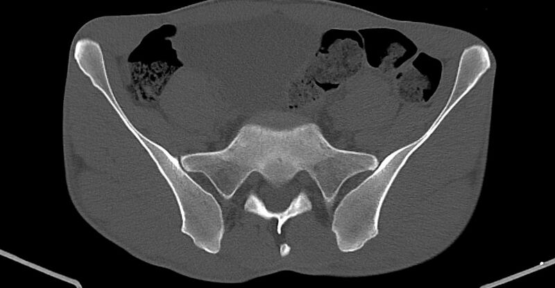 File:Chronic osteomyelitis (with sequestrum) (Radiopaedia 74813-85822 Axial non-contrast 4).jpg