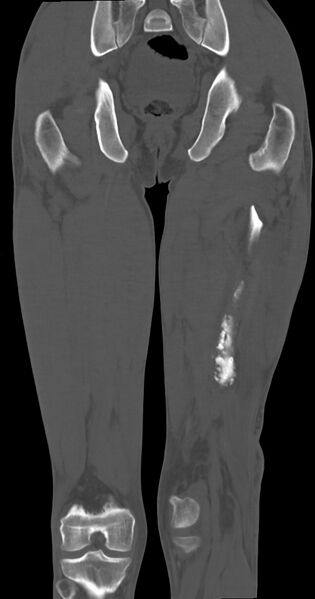 File:Chronic osteomyelitis (with sequestrum) (Radiopaedia 74813-85822 Coronal non-contrast 37).jpg