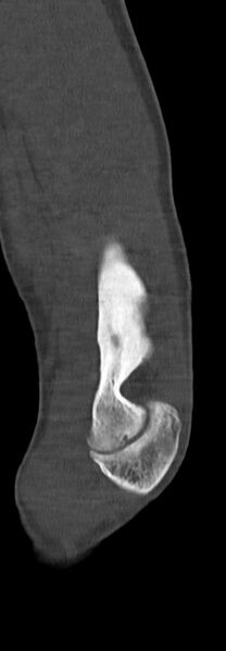 File:Chronic osteomyelitis of the distal humerus (Radiopaedia 78351-90971 Sagittal bone window 56).jpg