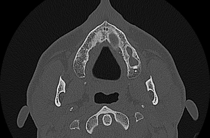 File:Chronic rhinosinusitis (Radiopaedia 65079-74075 Axial bone window 4).jpg