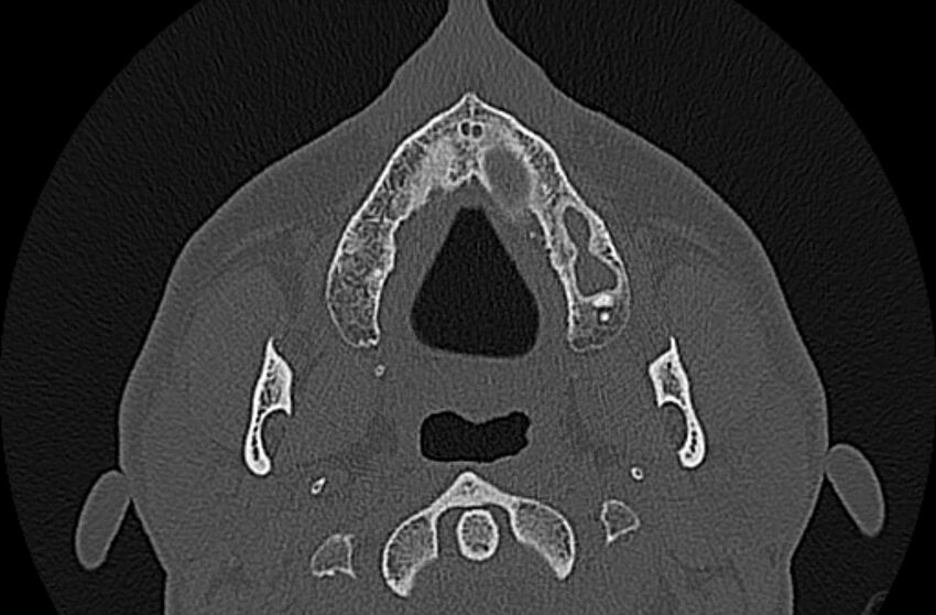 Chronic rhinosinusitis (Radiopaedia 65079-74075 Axial bone window 4).jpg