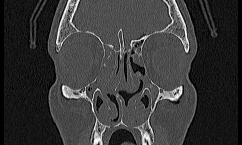 File:Chronic rhinosinusitis (Radiopaedia 65079-74075 Coronal bone window 25).jpg