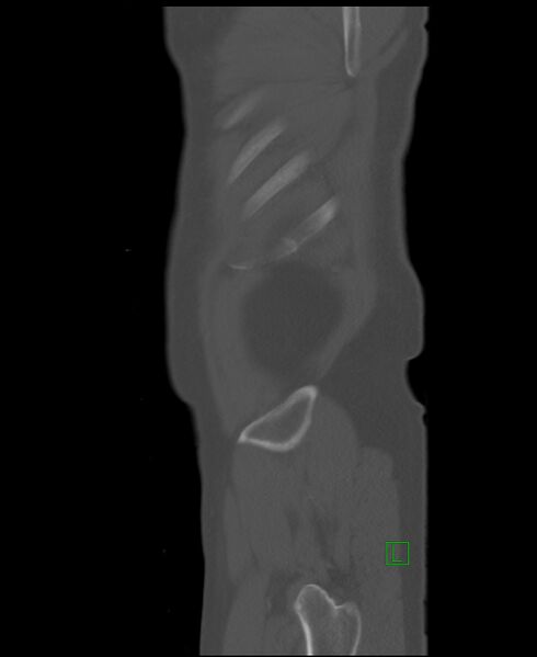 File:Clear cell renal cell carcinoma (Radiopaedia 85006-100539 Sagittal bone window 4).jpg