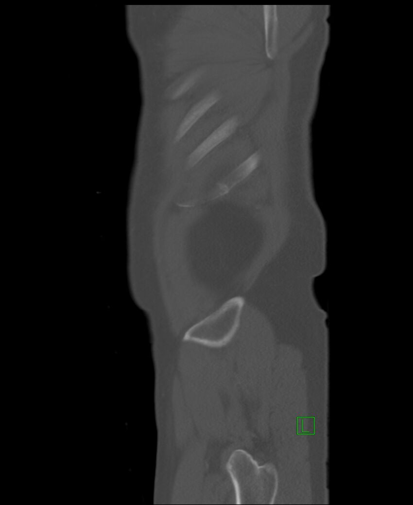 Clear cell renal cell carcinoma (Radiopaedia 85006-100539 Sagittal bone window 4).jpg