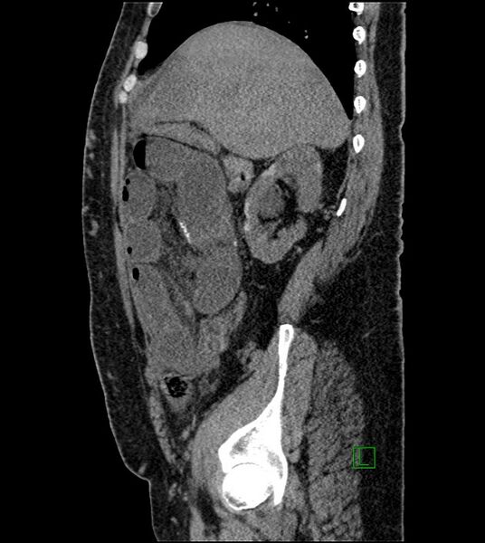 File:Closed-loop small bowel obstruction-internal hernia (Radiopaedia 78439-91096 C 104).jpg