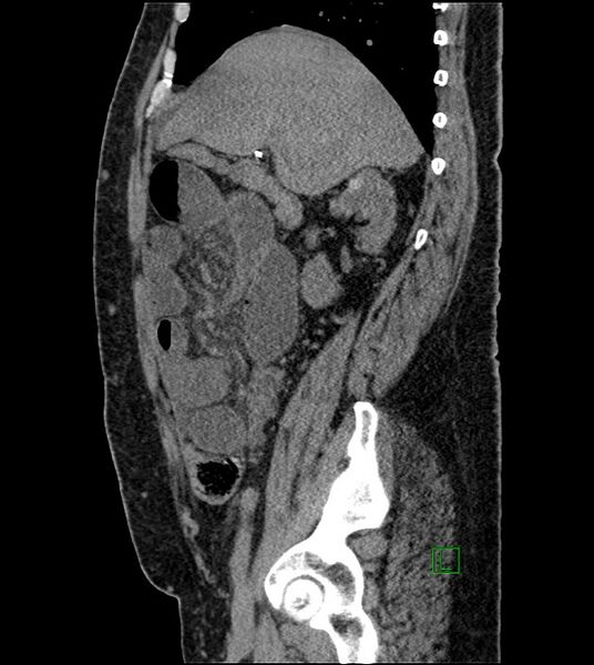 File:Closed-loop small bowel obstruction-internal hernia (Radiopaedia 78439-91096 C 98).jpg
