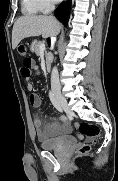 File:Closed loop small bowel obstruction - internal hernia (Radiopaedia 57806-64778 C 61).jpg