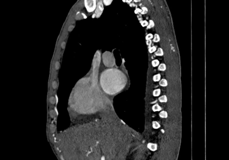 File:Coarctation of aorta with aortic valve stenosis (Radiopaedia 70463-80574 B 14).jpg