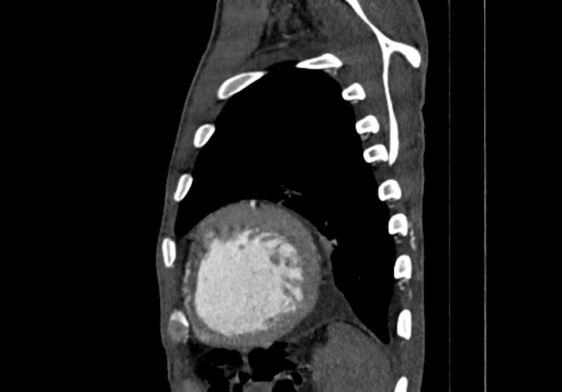 File:Coarctation of aorta with aortic valve stenosis (Radiopaedia 70463-80574 B 201).jpg