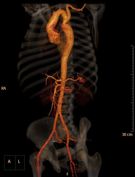 File:Coarctation of the aorta (Radiopaedia 49784-55050 3D VRT 20).jpg