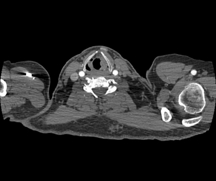 File:Coarctation of the aorta (Radiopaedia 53752-59822 A 1).jpg